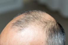 male baldness